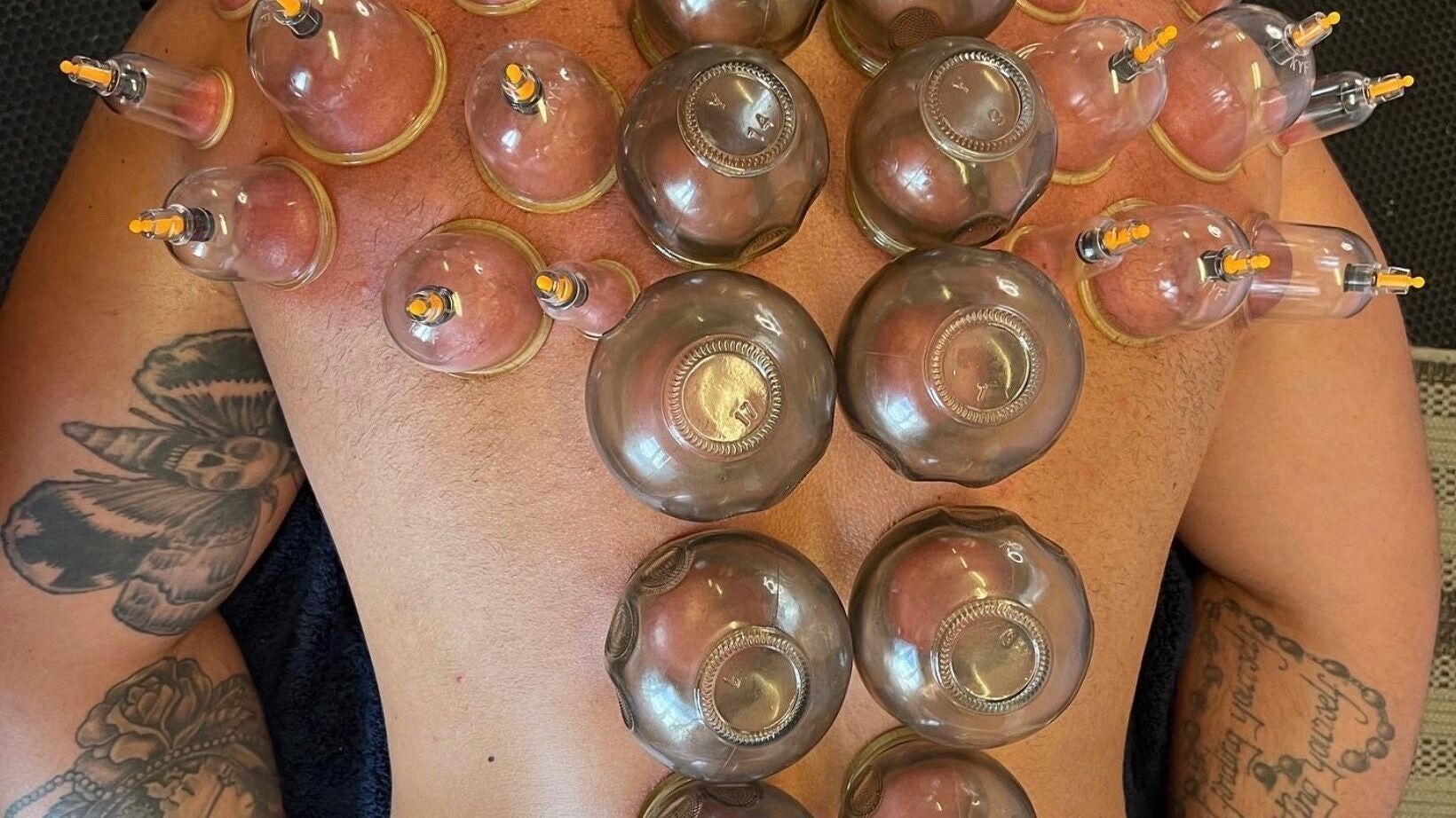 Glass cups placed in rows on a client’s back during cupping